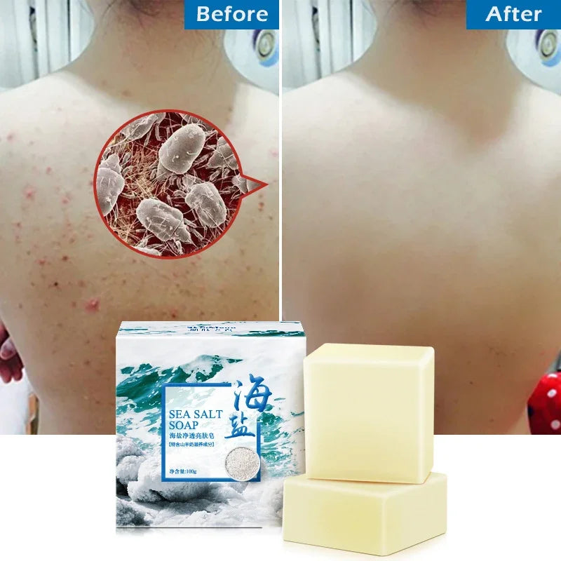 Sea Salt Soap Bar - Whitening and Moisturizing Face and Body Cleanser for Acne Treatment