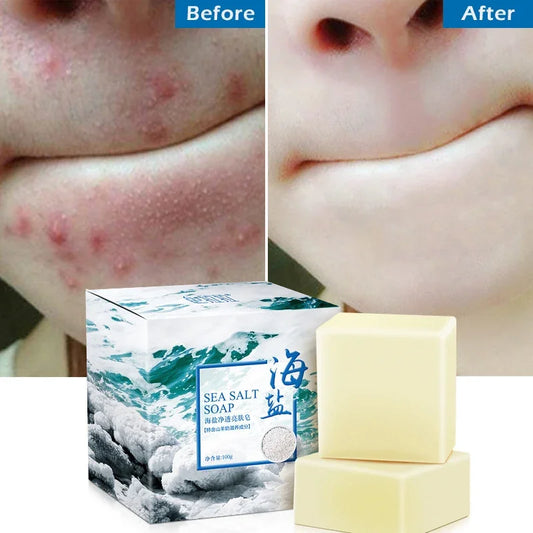 Sea Salt Soap Bar - Whitening and Moisturizing Face and Body Cleanser for Acne Treatment